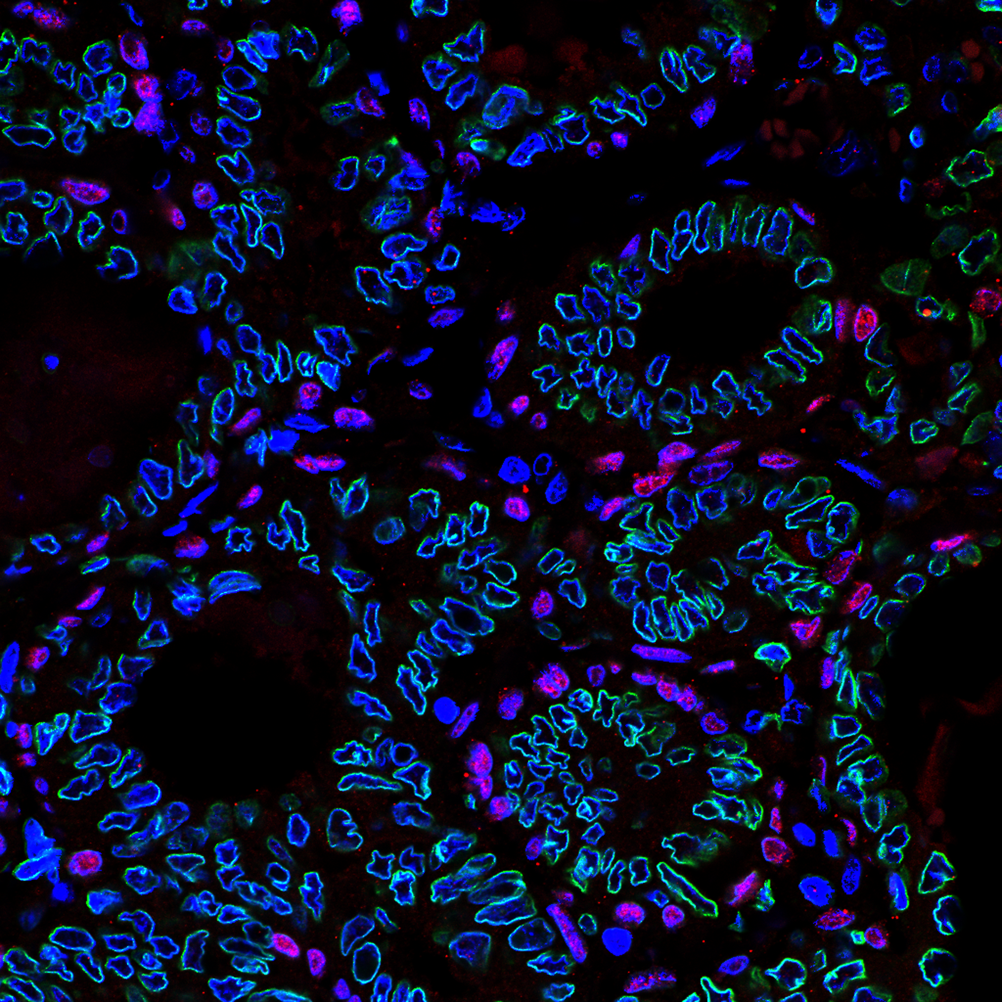 Tumor Histopathology Slide - Dr. Geovanni Cassali